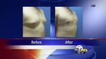 Male Breast Surgery Featured on ABC 7