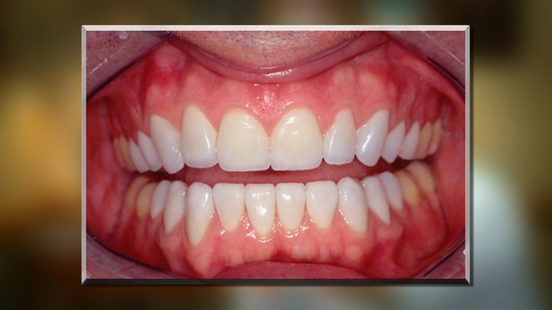 Smile Design Hartford, CT Dr. Steven Balloch