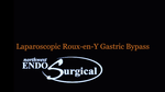 Gastric Bypass Surgery
