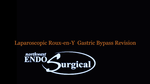 Gastric Bypass Revision