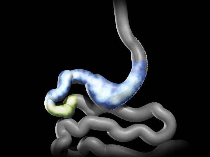 Sleeve Gastrectomy Houston, TX Dr. Matthew St. Laurent