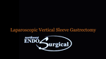 Gastric Sleeve Surgery