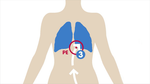 Pulmonary Embolism Lawsuit