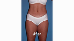 Tummy Tuck