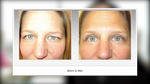 Blepharoplasty