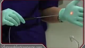 Laser-Assisted Liposuction in San Antonio, Texas