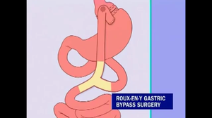 Gastric Bypass Surgery