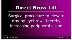 Direct Brow Lift Surgery