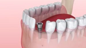 "A dental implant is basically a bionic root."