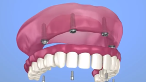 Types of Dentures