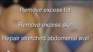 Abdominoplasty Can Restore Your Midsection