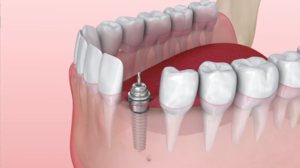"Patients with Missing Teeth Benefit from Dental Implants"
