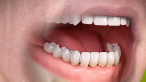 Dental Implants Review