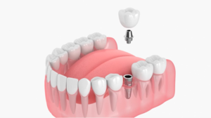 Dental Implants versus Traditional Restorations 