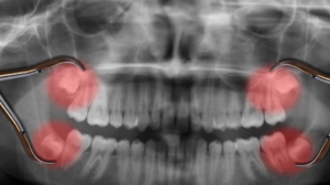 Wisdom Teeth Removal