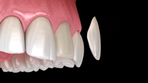 Beautify Your Smile with Veneers
