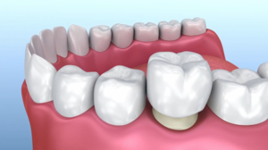 Protect Your Teeth for Years to Come