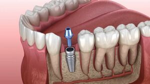 Replace Missing Teeth