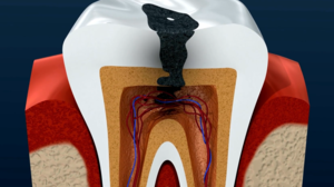 Do I Need a Root Canal?