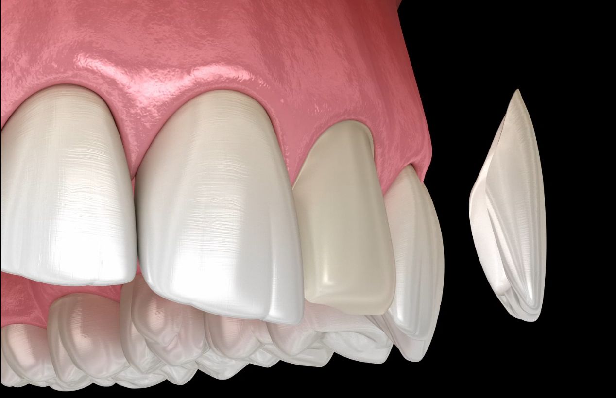 Veneers Scottsdale, AZ Phoenix, AZ Dental Works