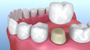 Restore and Protect a Compromised Tooth