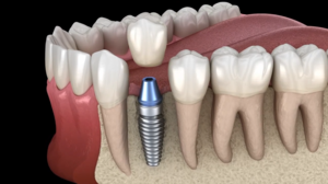 Fill the Gaps in Your Smile
