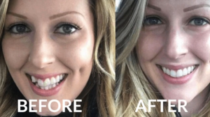 Straighter Teeth without Braces
