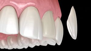 A Stunning Smile in Two Appointments