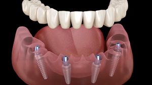 Dentures That Look & Feel Natural