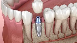 Replace Teeth with the Most Advanced Option