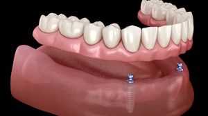 Replace All of Your Teeth at Once