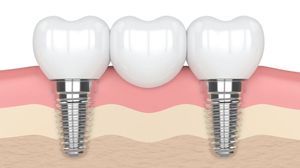 Fill Gaps in Your Smile