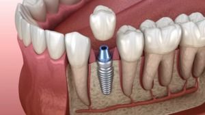 Fill Gaps in Your Smile with Dental Implants