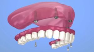 All-on-4® Implants Offer Unmatched Stability