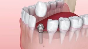 Replace Missing Teeth with Dental Implants
