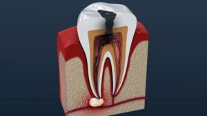 Root Canals Can Save and Repair an Infected Tooth