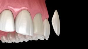 Veneers Transform Your Smile