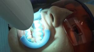 Brighten Your Smile with Teeth Whitening