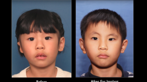 Microtia Treatment Options