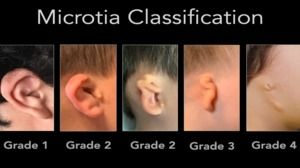 Types of Microtia