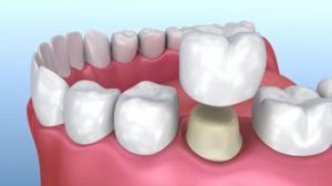 About Dental Crowns 