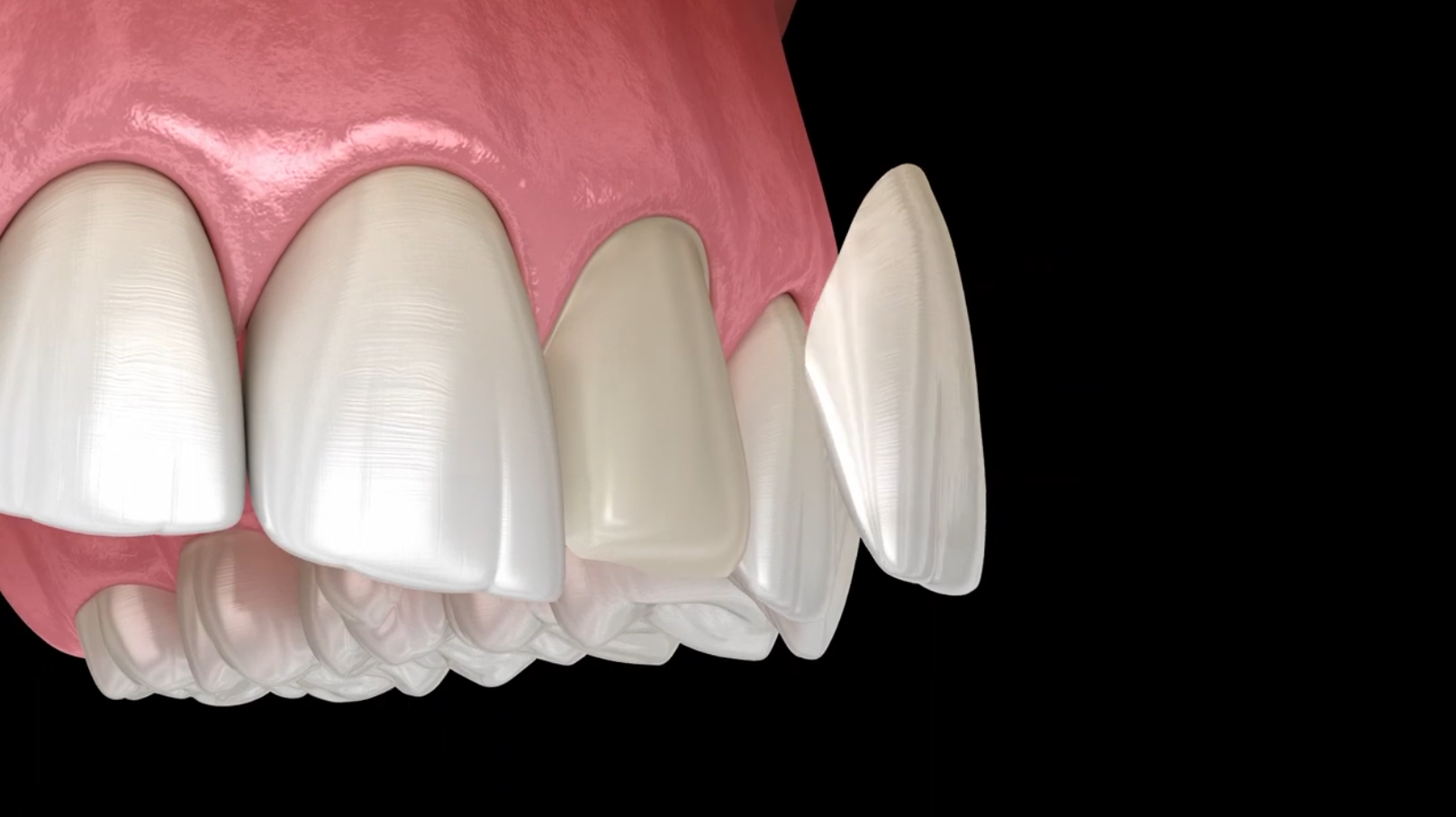 Dental Veneers Brooklyn, NY Brooklyn Heights, NY Dentistry at the