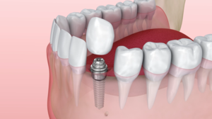 Dental Implants: A Realistic and Effective Tooth Replacement