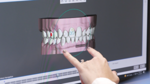 Clear Aligners: No More Brackets and Wires