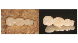 Dental Bridges: Replace Your Missing Tooth