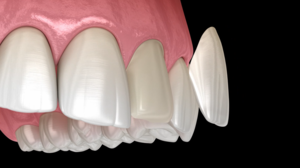 Hide Dental Imperfections With Veneers