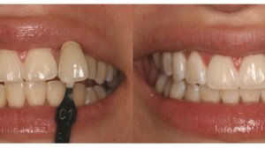 Achieve a Dazzling Smile With Professional Teeth Whitening