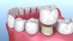 Dental Crowns: Strengthen Your Tooth