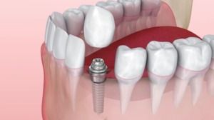 Dental Implants: Our First Choice for Tooth Replacement