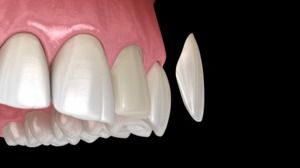 Dental Veneers: A Permanent Cosmetic Solution